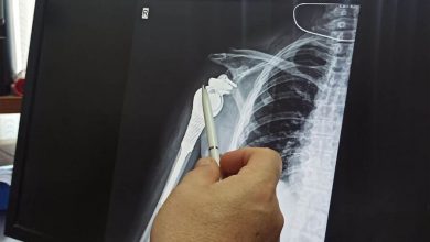Фото - В России научились печатать эндопротезы плеча для пациентов после онкозаболеваний
